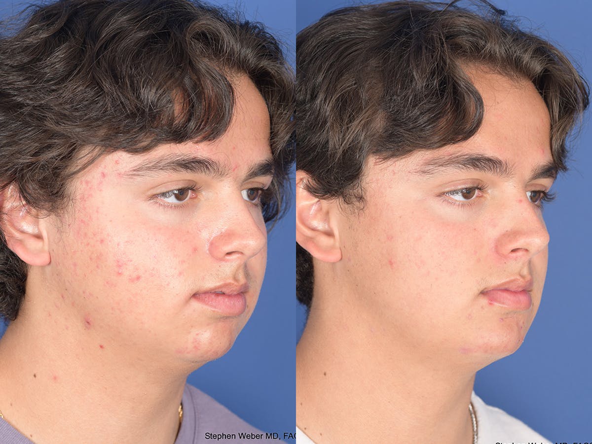 Chin Implant Before & After Gallery - Patient 320646 - Image 5