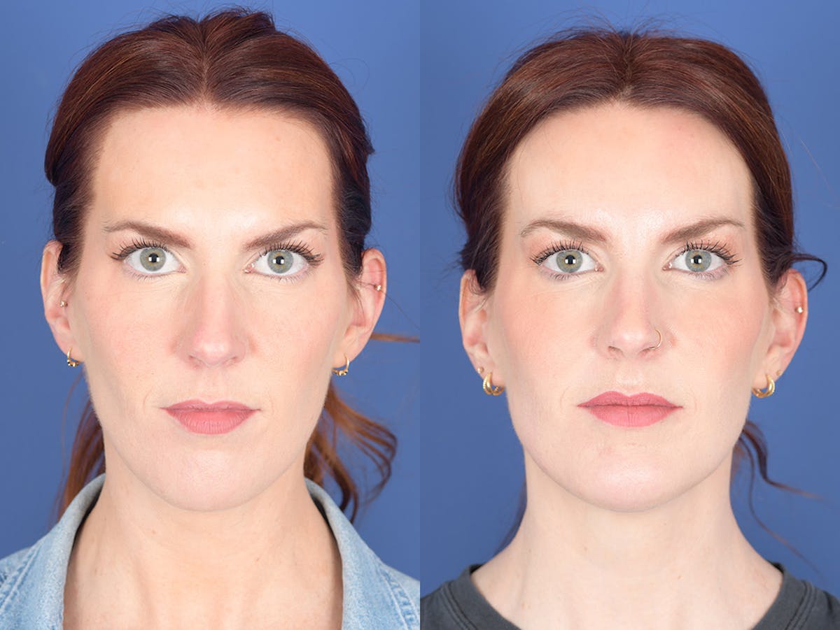 Necklift Before & After Gallery - Patient 240279 - Image 1