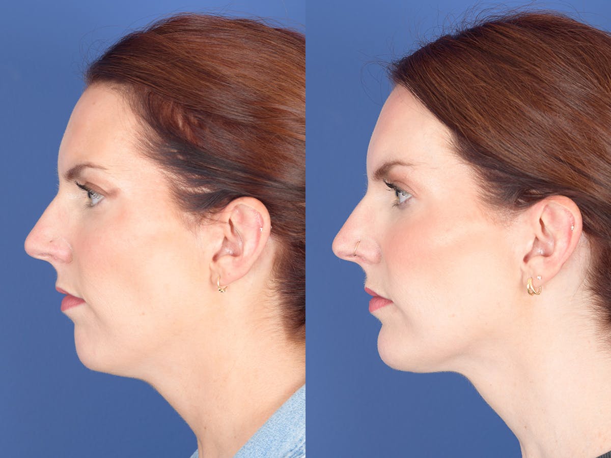 Necklift Before & After Gallery - Patient 240279 - Image 2
