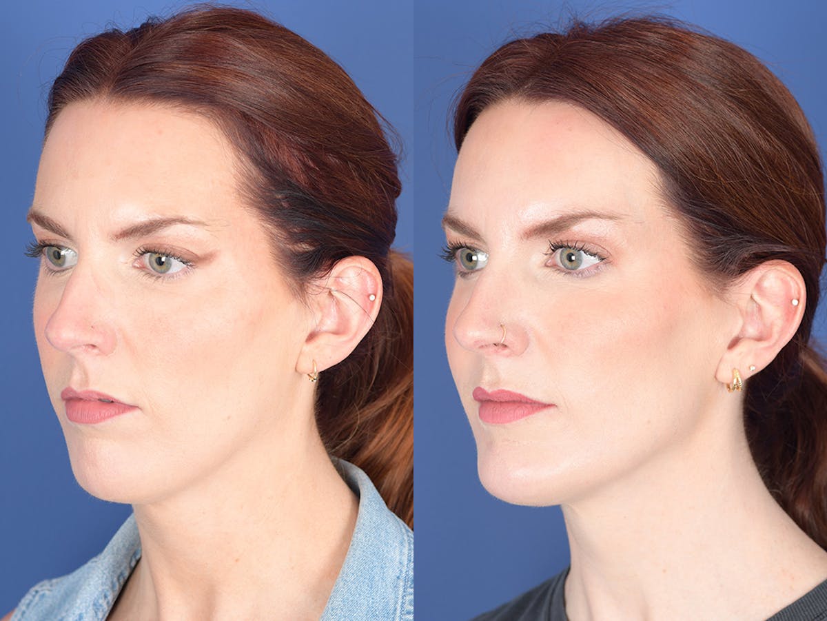 Necklift Before & After Gallery - Patient 240279 - Image 3