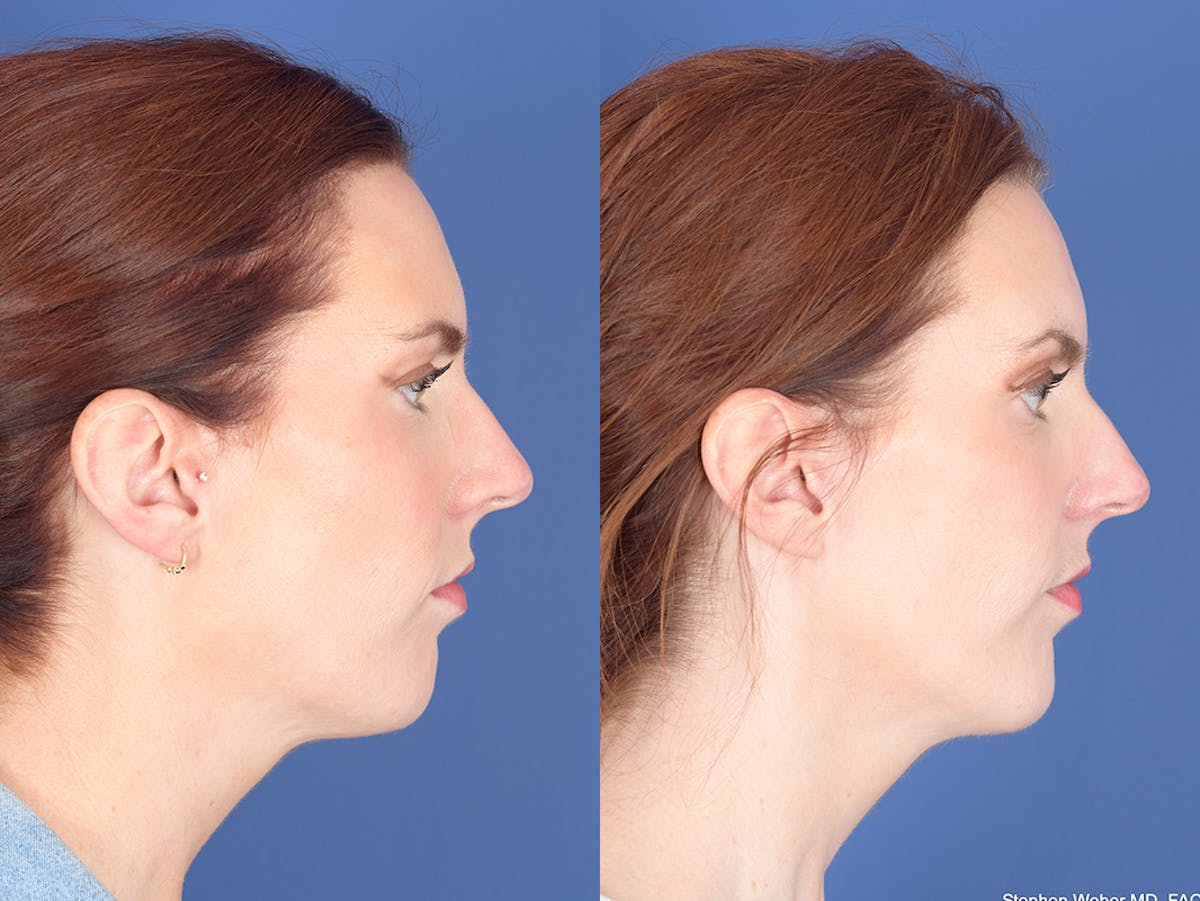 Necklift Before & After Gallery - Patient 240279 - Image 4