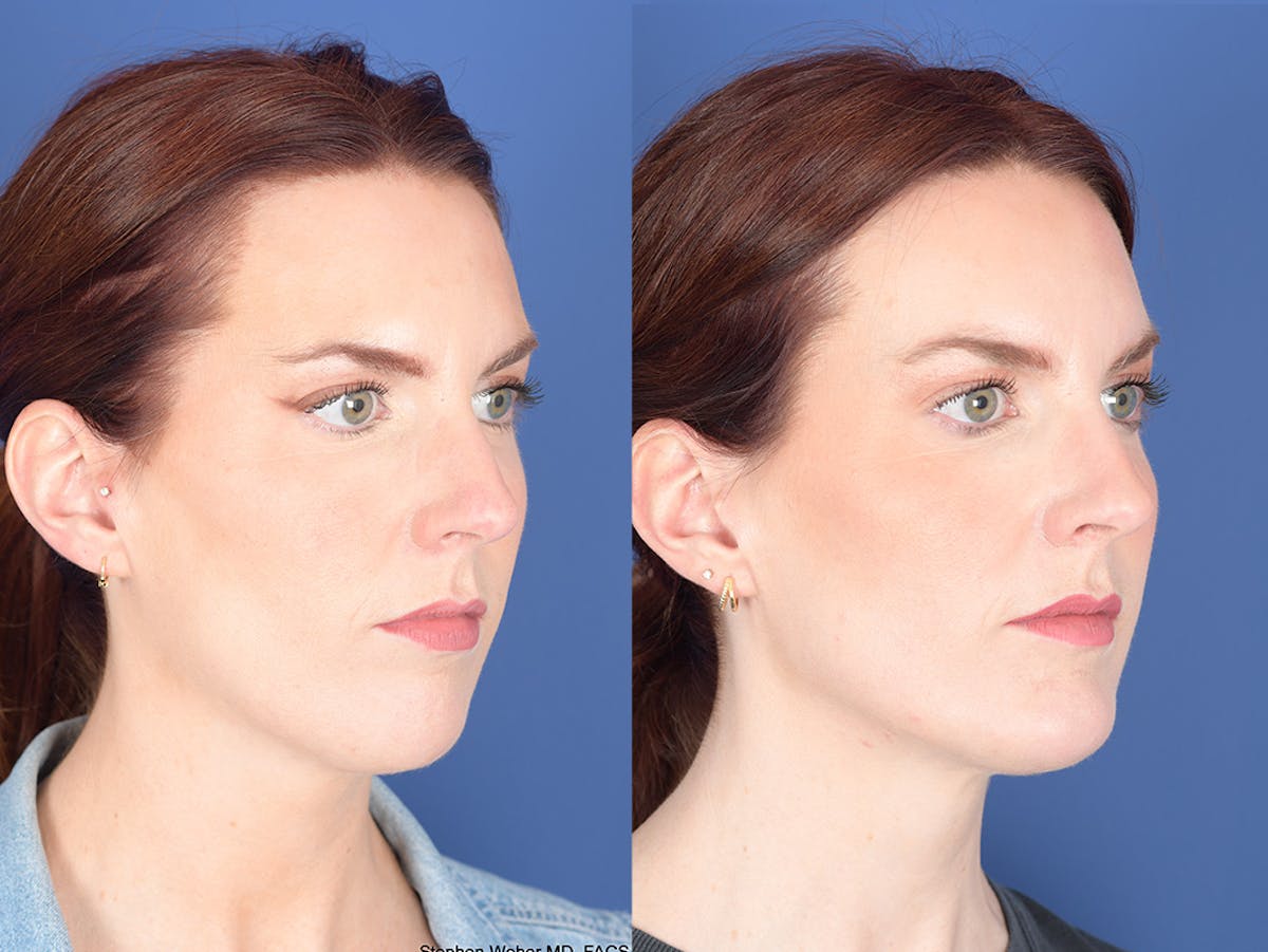Necklift Before & After Gallery - Patient 240279 - Image 5