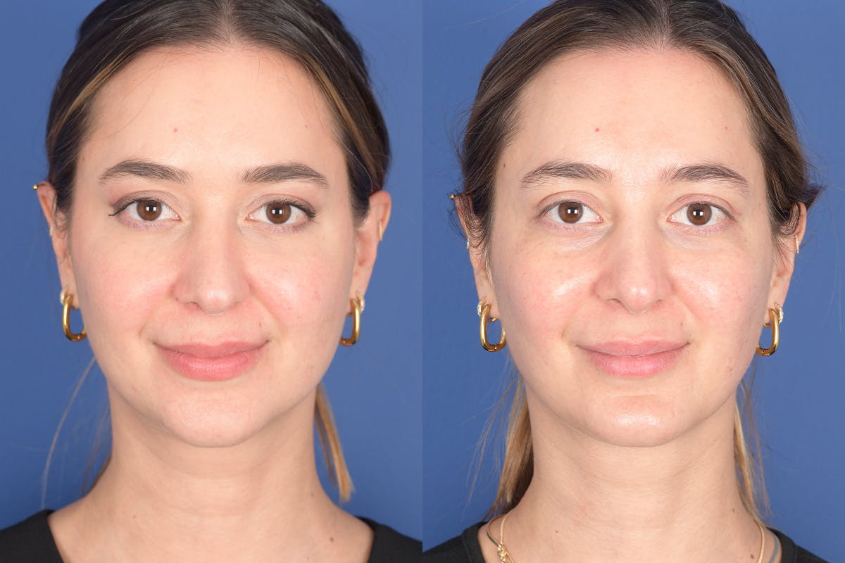 Necklift Before & After Gallery - Patient 104422 - Image 1