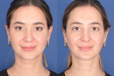 Necklift Before & After Gallery - Patient 104422 - Image 1