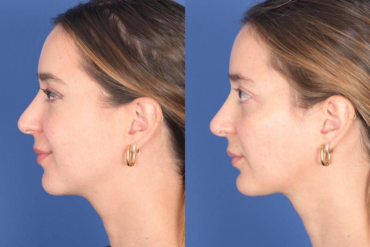 Necklift Before & After Gallery - Patient 104422 - Image 2
