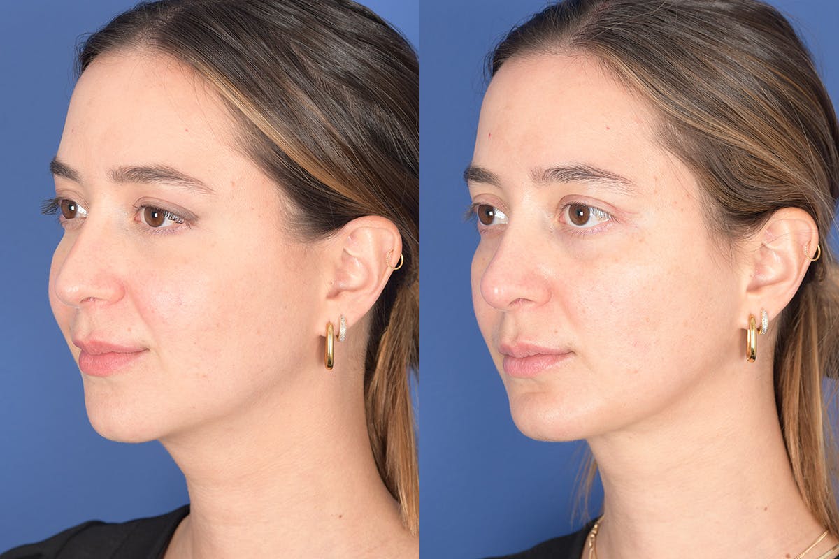 Necklift Before & After Gallery - Patient 104422 - Image 3