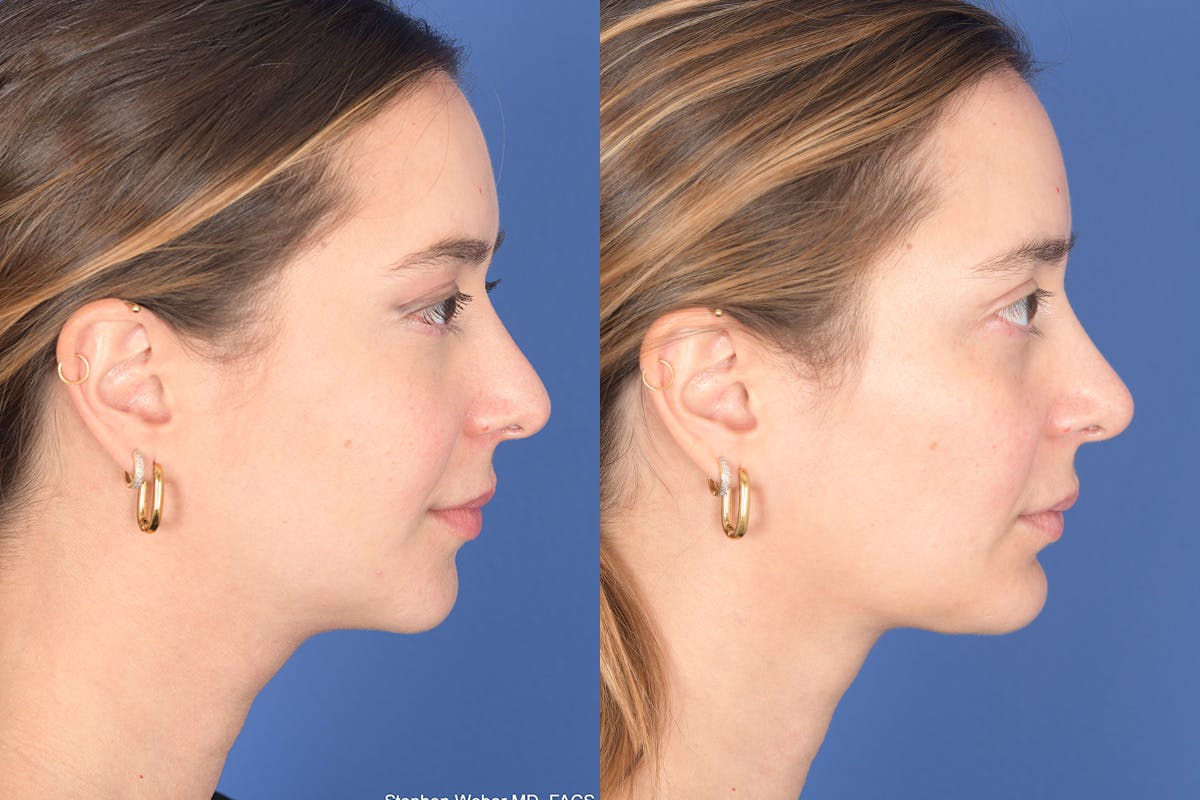 Necklift Before & After Gallery - Patient 104422 - Image 4
