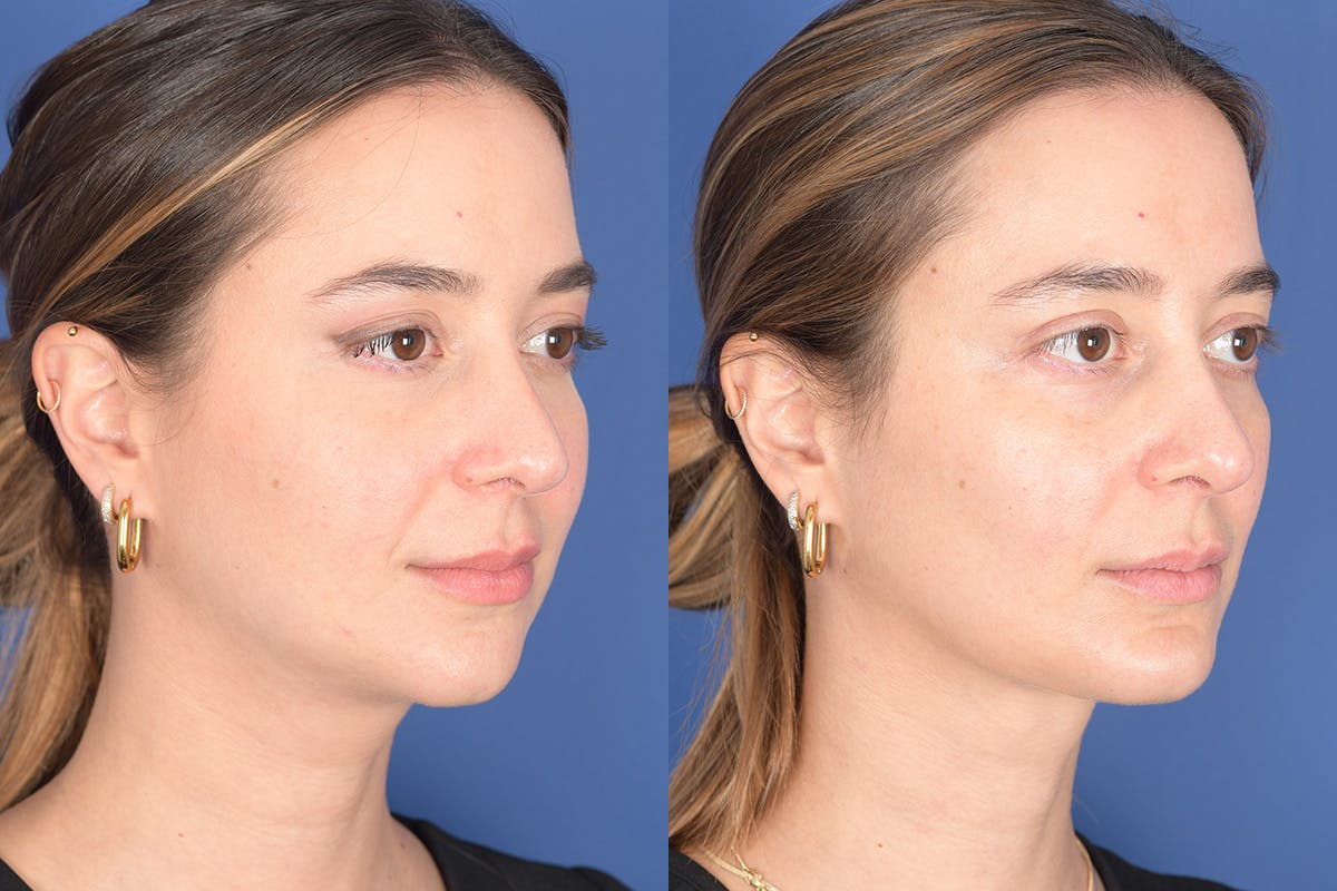 Necklift Before & After Gallery - Patient 104422 - Image 5