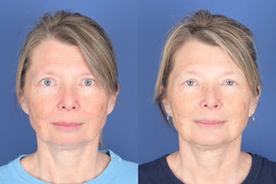 Chin Implant Before & After Gallery - Patient 103982 - Image 1