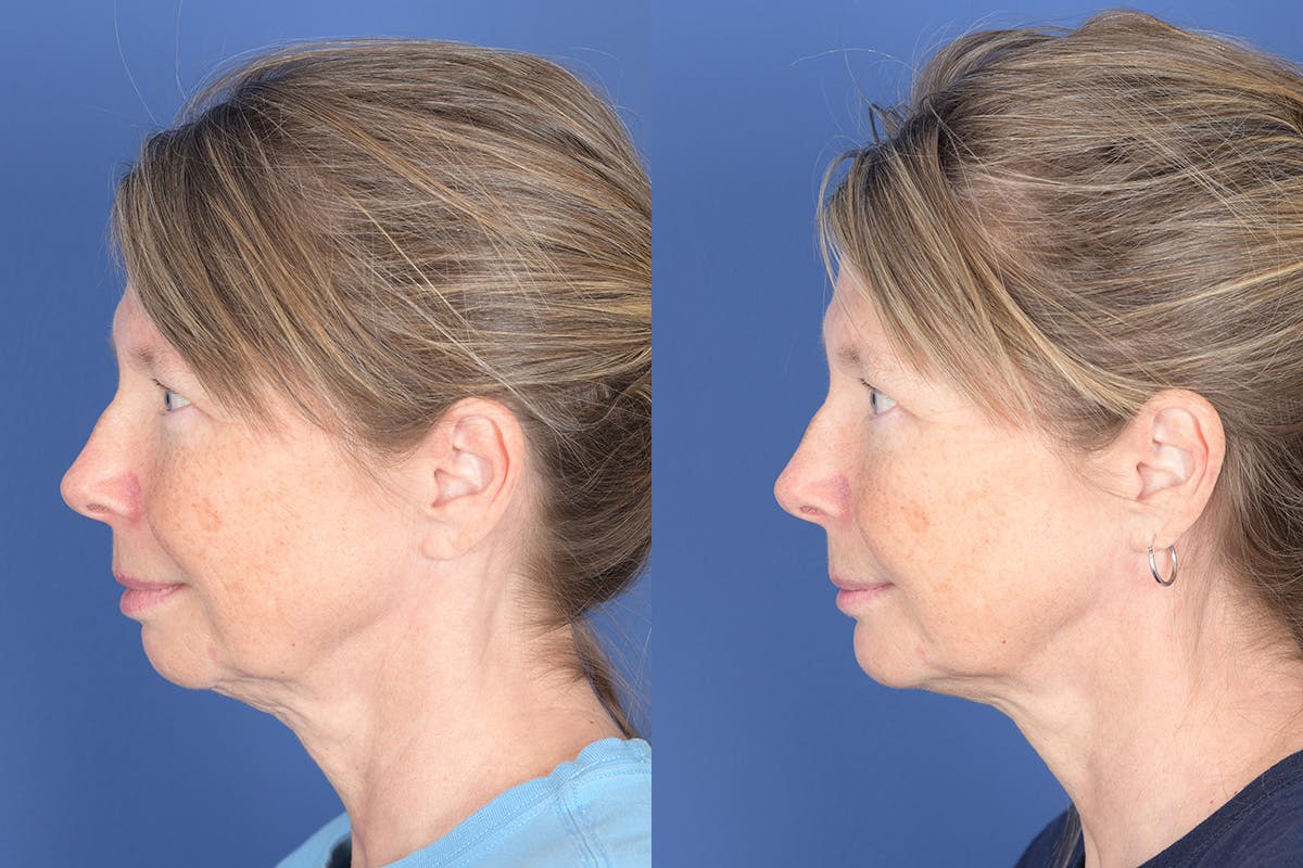 Chin Implant Before & After Gallery - Patient 103982 - Image 2