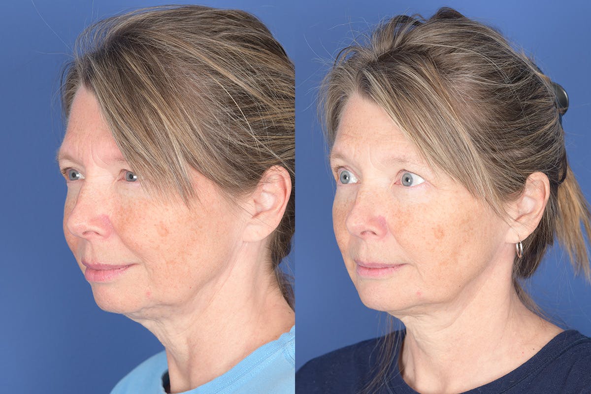 Chin Implant Before & After Gallery - Patient 103982 - Image 3