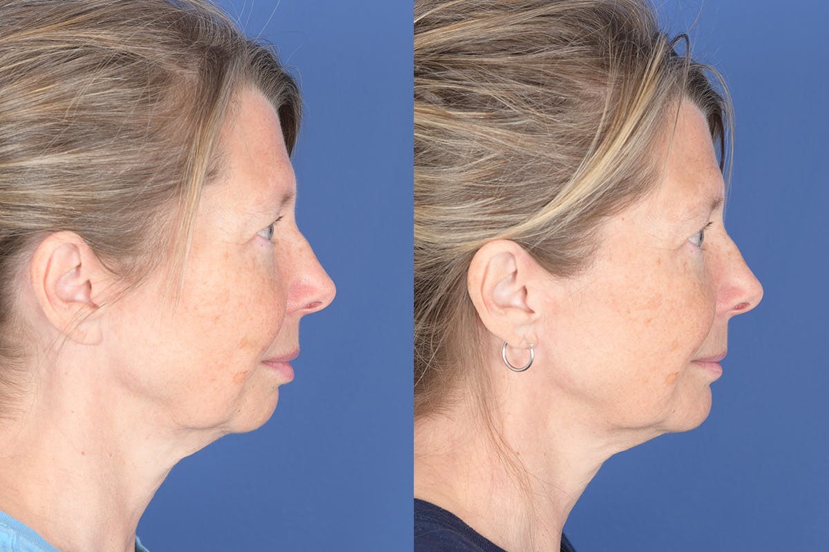 Chin Implant Before & After Gallery - Patient 103982 - Image 4