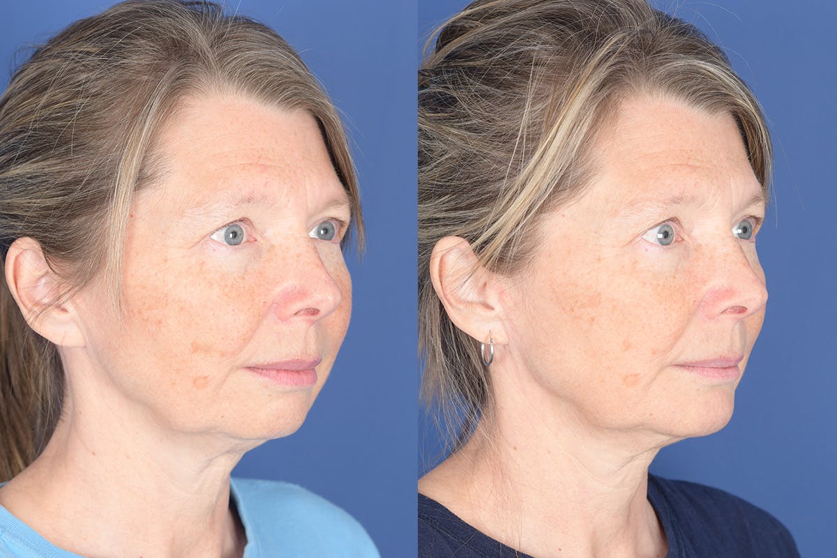 Chin Implant Before & After Gallery - Patient 103982 - Image 5