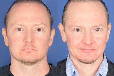 Chin Implant Before & After Gallery - Patient 319520 - Image 1