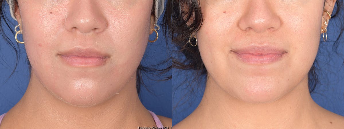 Chin Implant Before & After Gallery - Patient 367223 - Image 1