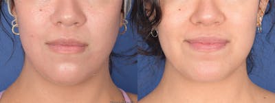 Chin Implant Before & After Gallery - Patient 367223 - Image 1