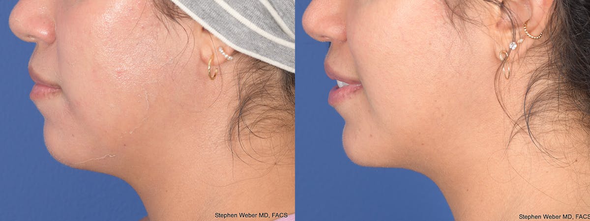 Chin Implant Before & After Gallery - Patient 367223 - Image 2