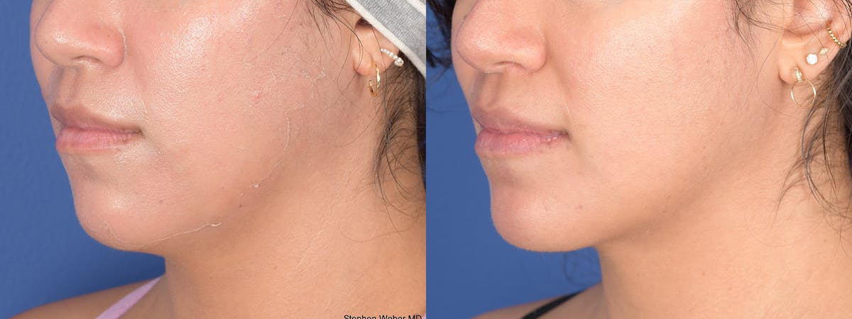 Chin Implant Before & After Gallery - Patient 367223 - Image 3