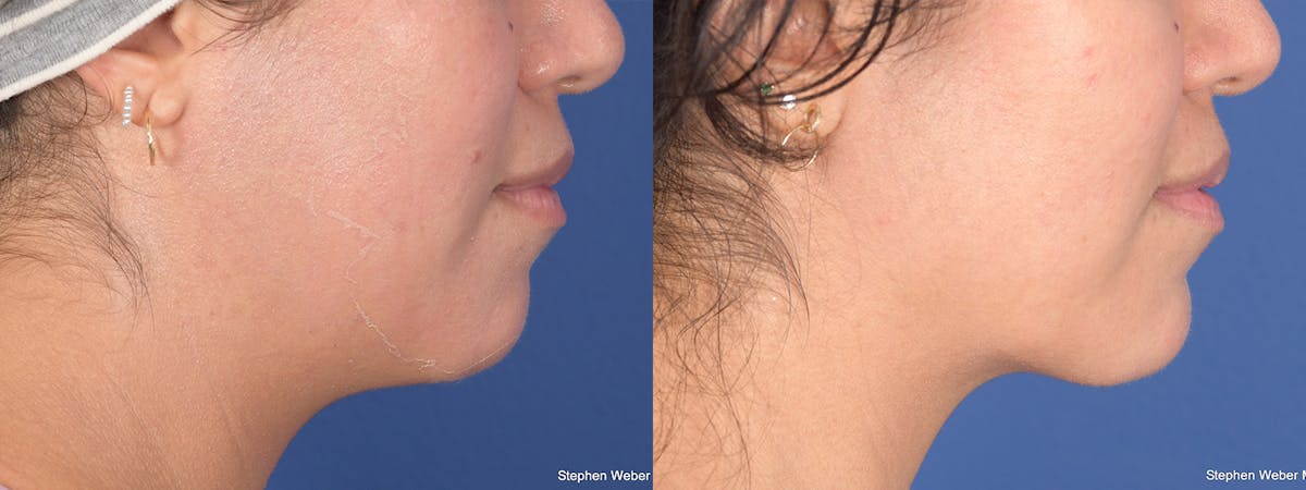 Chin Implant Before & After Gallery - Patient 367223 - Image 4