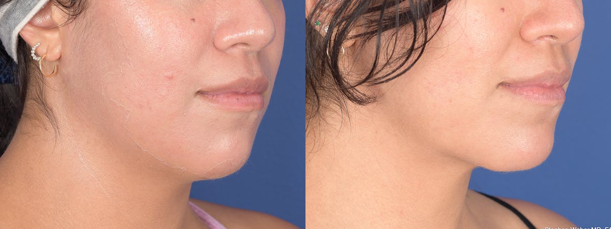Chin Implant Before & After Gallery - Patient 367223 - Image 5