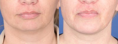 Chin Implant Before & After Gallery - Patient 406285 - Image 1