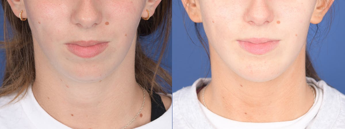Chin Implant Before & After Gallery - Patient 326633 - Image 1