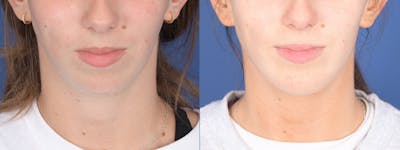Chin Implant Before & After Gallery - Patient 326633 - Image 1