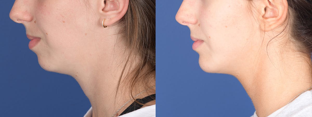 Chin Implant Before & After Gallery - Patient 326633 - Image 2
