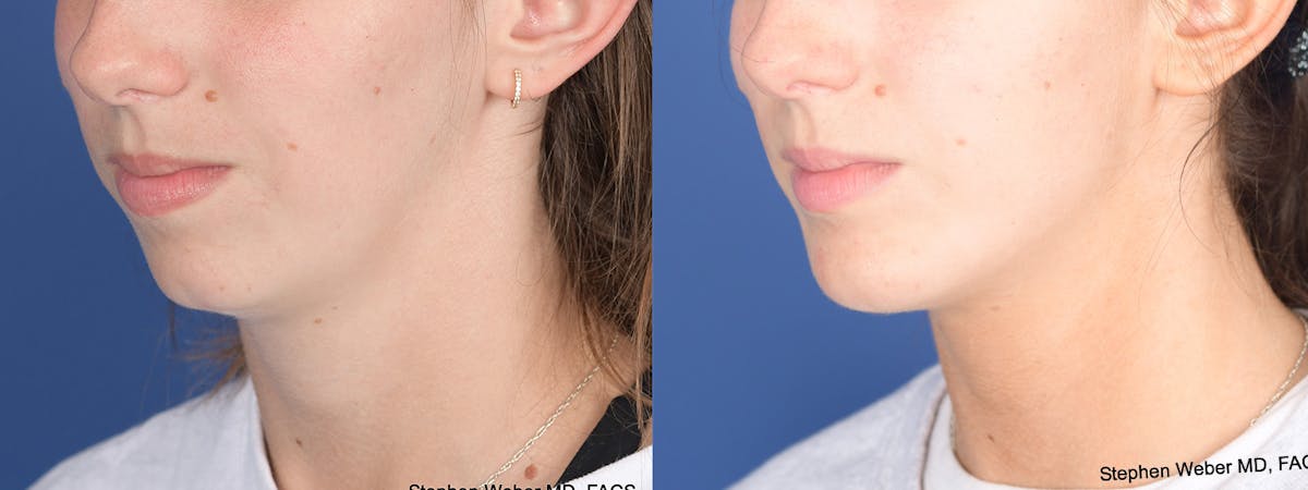 Chin Implant Before & After Gallery - Patient 326633 - Image 3