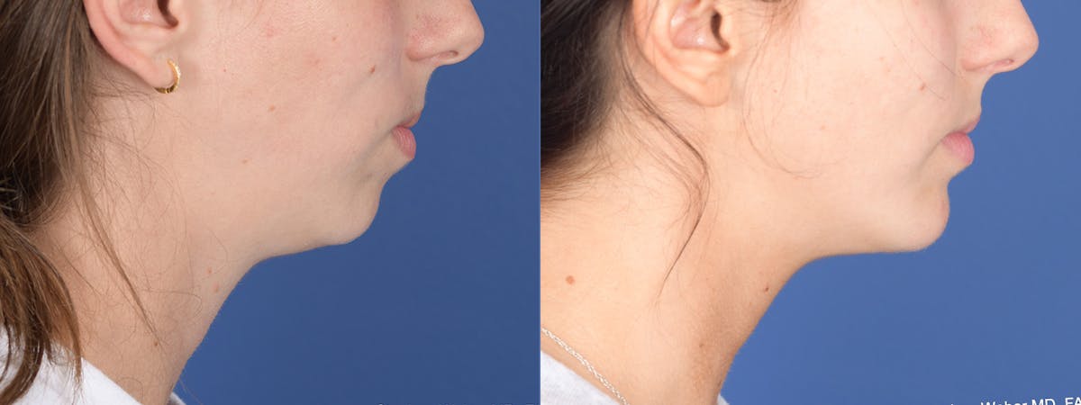 Chin Implant Before & After Gallery - Patient 326633 - Image 4