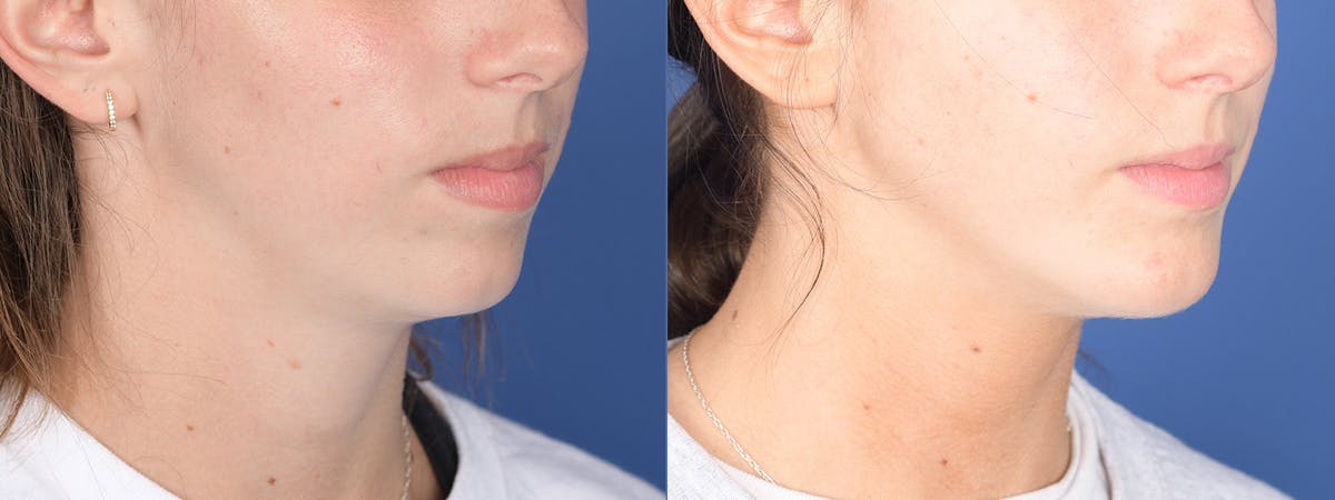 Chin Implant Before & After Gallery - Patient 326633 - Image 5
