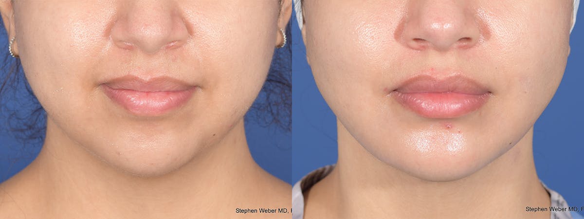 Chin Implant Before & After Gallery - Patient 491287 - Image 1