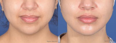 Chin Implant Before & After Gallery - Patient 491287 - Image 1