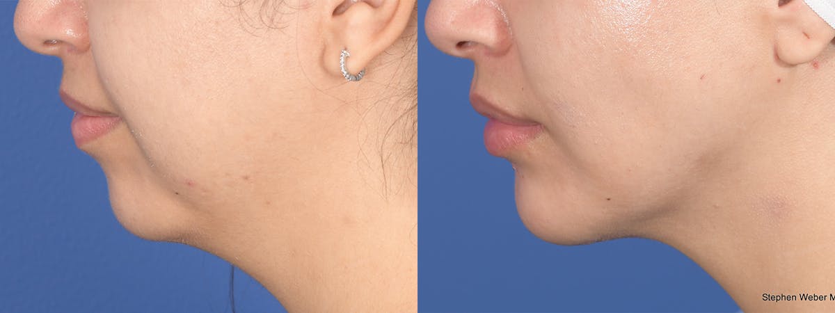 Chin Implant Before & After Gallery - Patient 491287 - Image 2