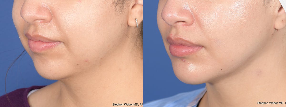 Chin Implant Before & After Gallery - Patient 491287 - Image 3