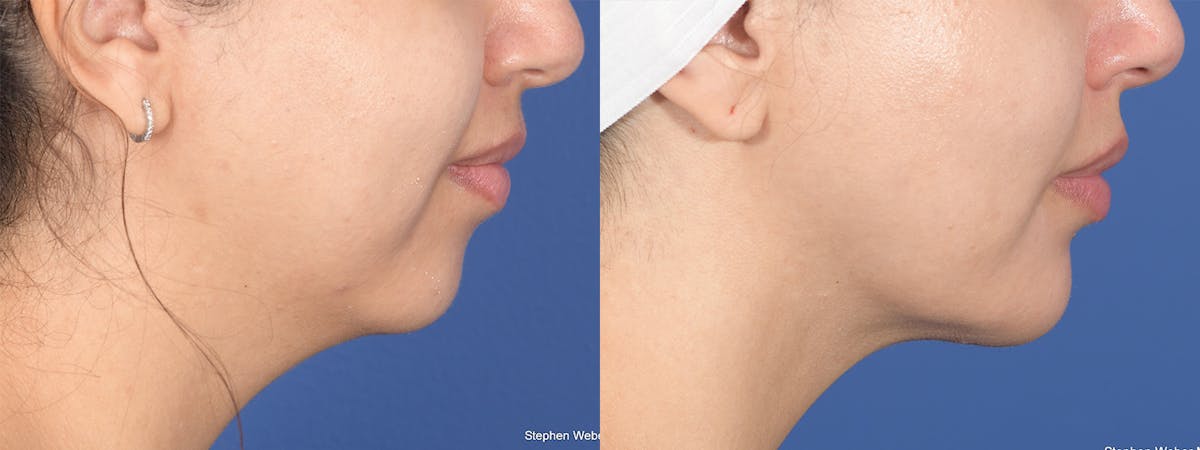Chin Implant Before & After Gallery - Patient 491287 - Image 4
