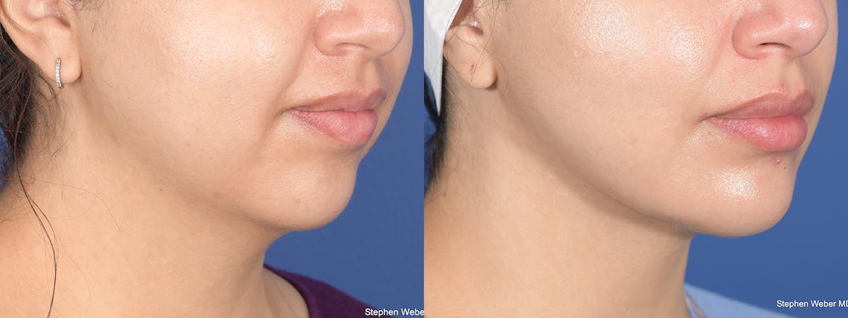 Chin Implant Before & After Gallery - Patient 491287 - Image 5