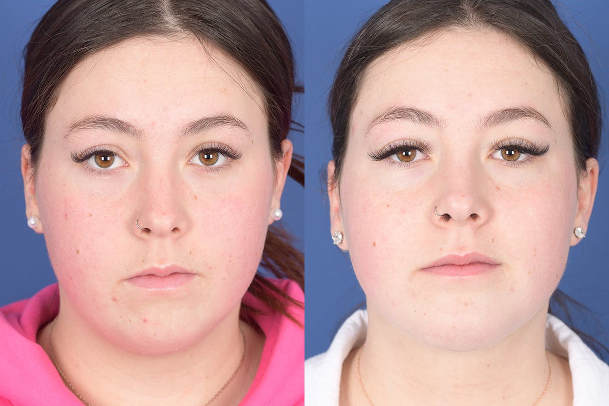 Chin Implant Before & After Gallery - Patient 102835 - Image 1