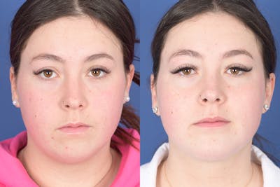 Necklift Before & After Gallery - Patient 368478 - Image 1