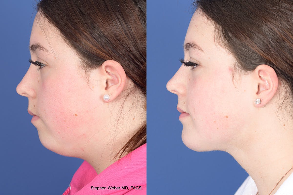 Chin Implant Before & After Gallery - Patient 102835 - Image 2