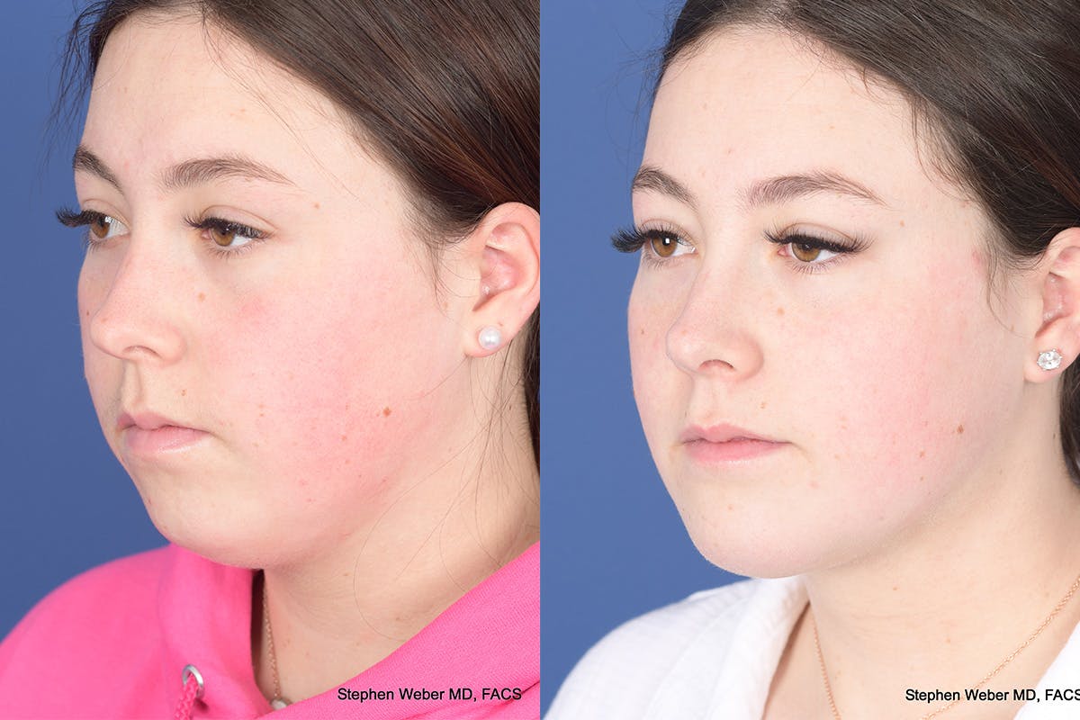 Chin Implant Before & After Gallery - Patient 102835 - Image 3