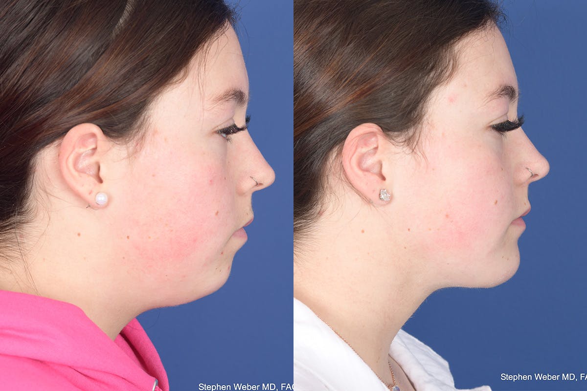 Chin Implant Before & After Gallery - Patient 102835 - Image 4