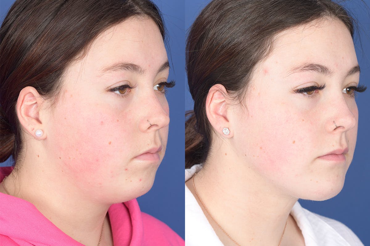 Chin Implant Before & After Gallery - Patient 102835 - Image 5