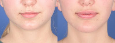 Chin Implant Before & After Gallery - Patient 452969 - Image 1