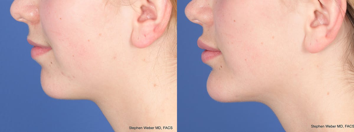 Chin Implant Before & After Gallery - Patient 452969 - Image 2