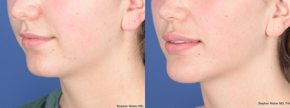 Chin Implant Before & After Gallery - Patient 452969 - Image 3