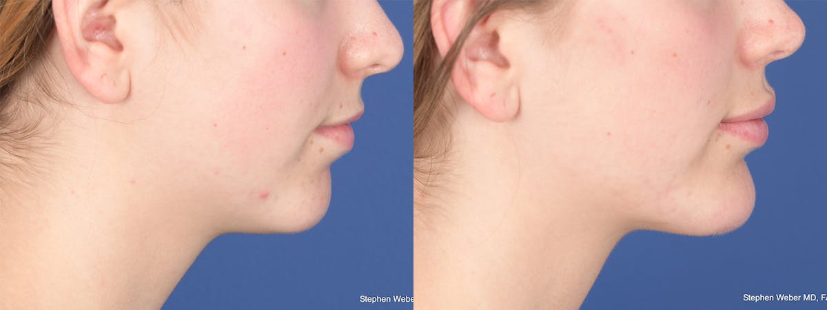 Chin Implant Before & After Gallery - Patient 452969 - Image 4