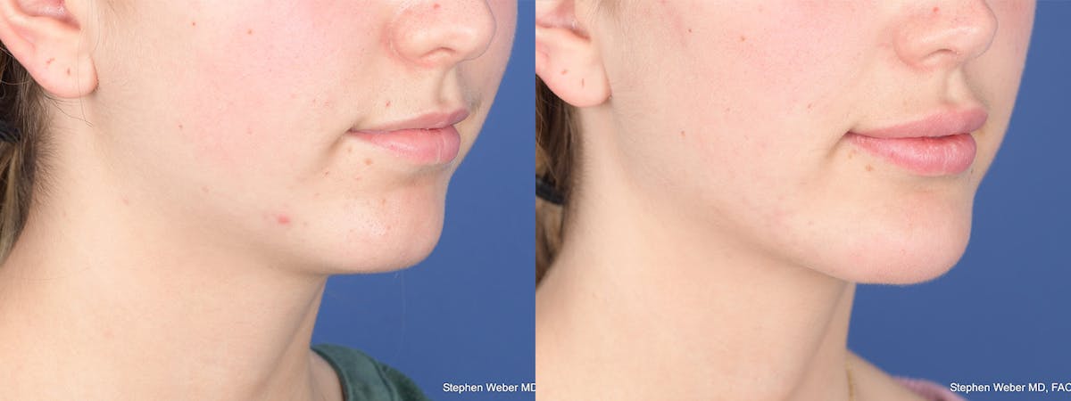 Chin Implant Before & After Gallery - Patient 452969 - Image 5