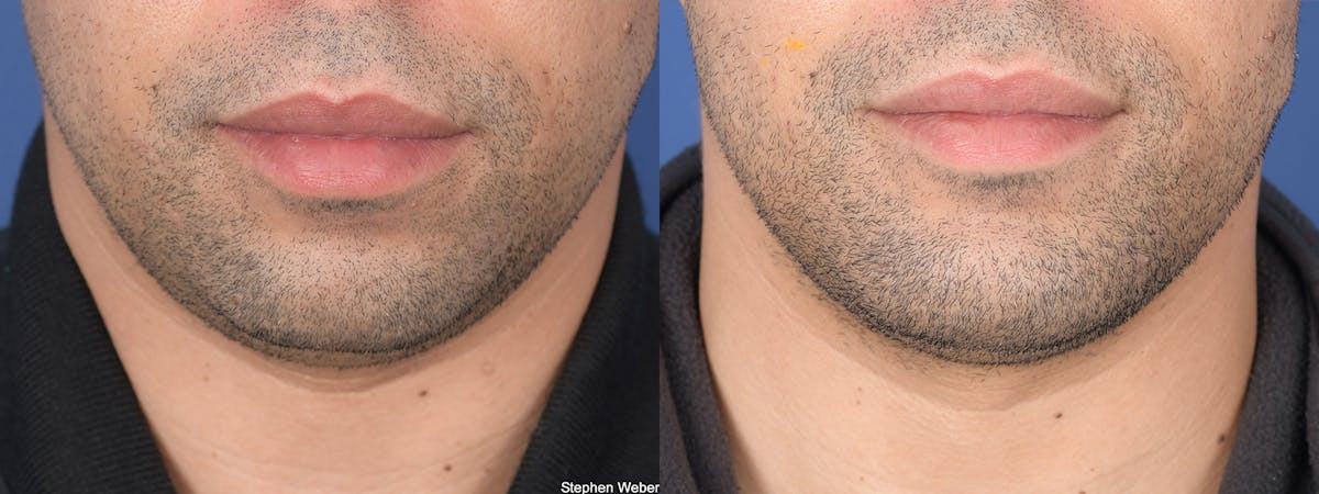 Chin Implant Before & After Gallery - Patient 128884 - Image 1