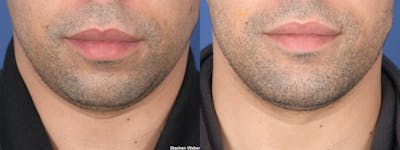 Chin Implant Before & After Gallery - Patient 128884 - Image 1